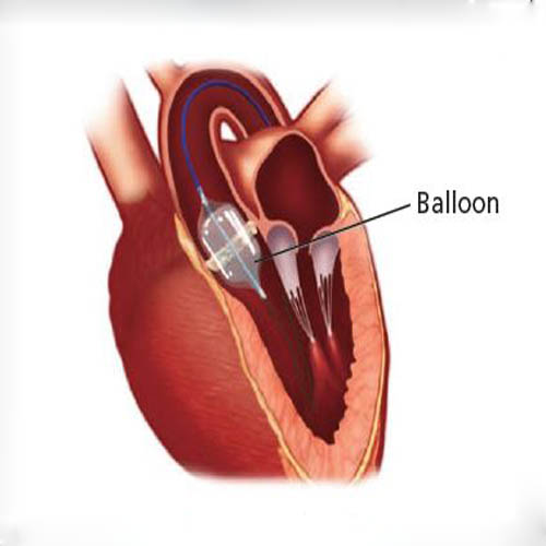 Best doctor for balloon valvotomy in indore