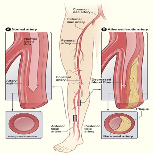 heart block treatment angioplasty in indore