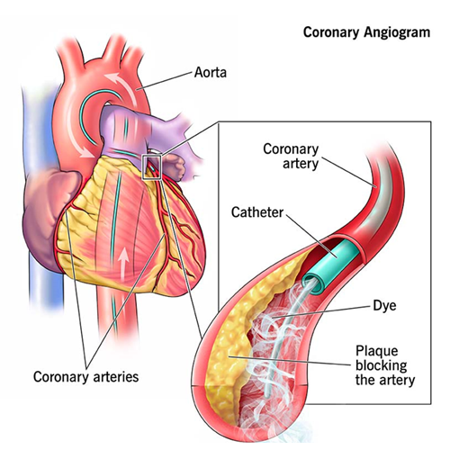 angiogram for heart blockage indore