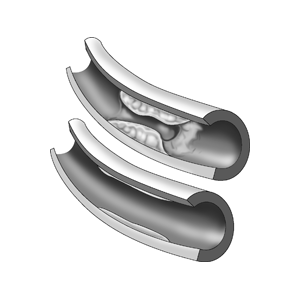 coronary angioplasty cost in indore