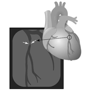 coronary angioplasty cost in indore