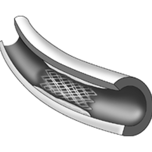 heart block treatment angioplasty in indore