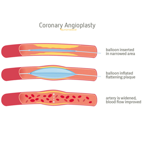 heart block treatment angioplasty in indore