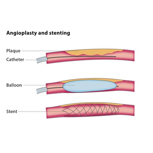 coronary angioplasty cost in indore