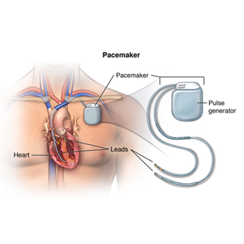 pacemaker implantation hospital in indore